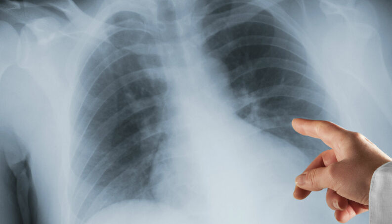 Casos de pneumonia infantil aumentam em Cabul com o iminente inverno