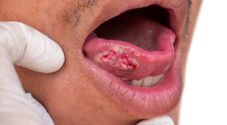 Jovens põem a “Língua Para Fora” para alertar para o cancro oral